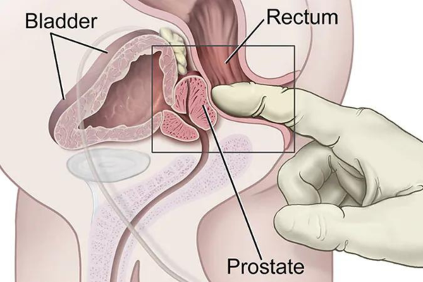 Treatment for Anal Cancer