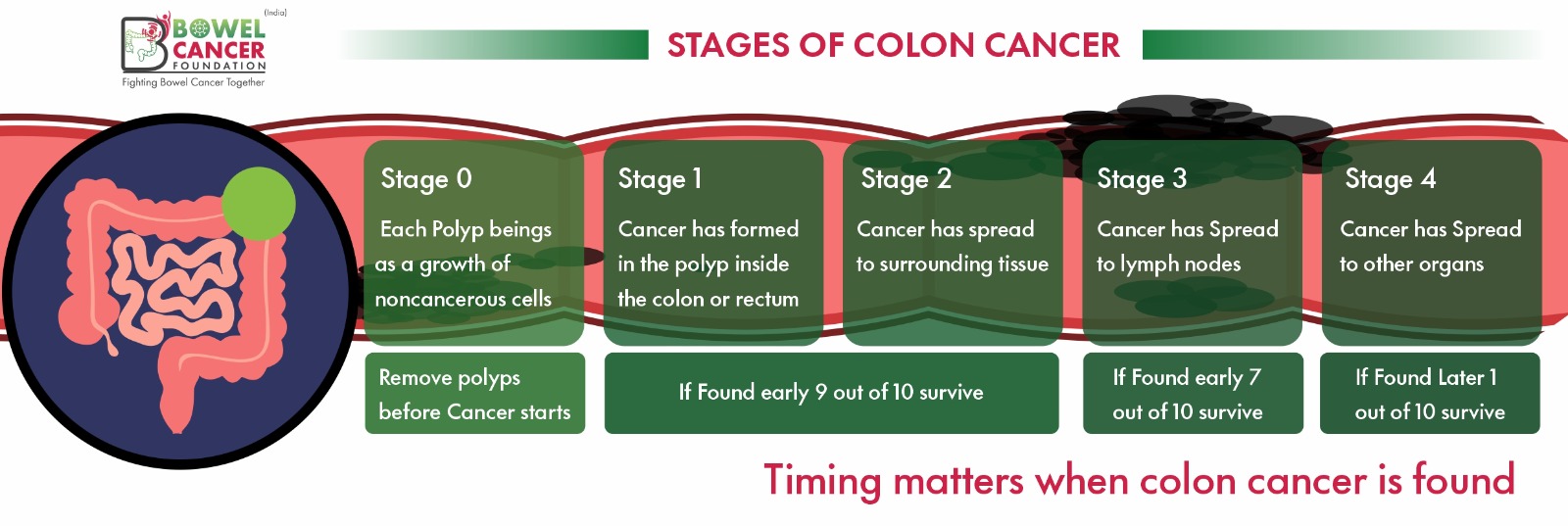 Stages of Bowel Cancer